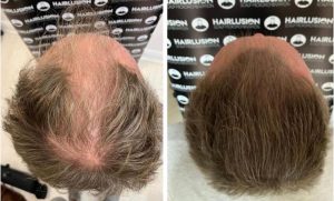 scalp micropigmentation treatment