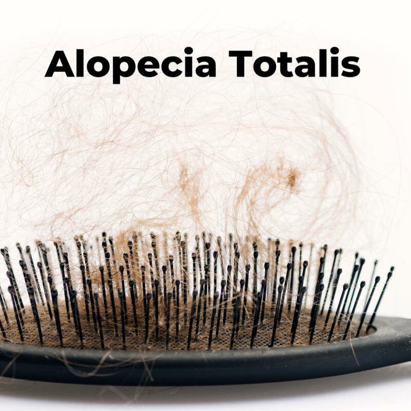 alopecia totalis causes symptoms and treatment