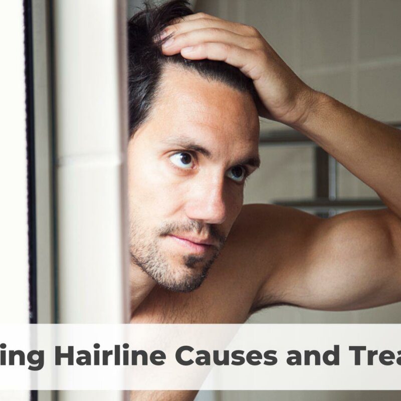 receding hairline causes and treatment
