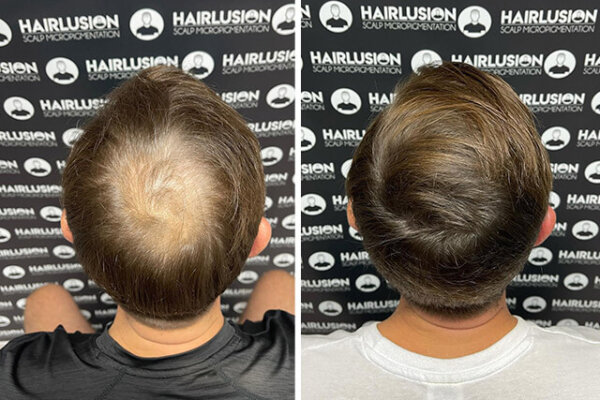 Hair-to-Ware-Scalp-Micropigmentation-Before-and-After
