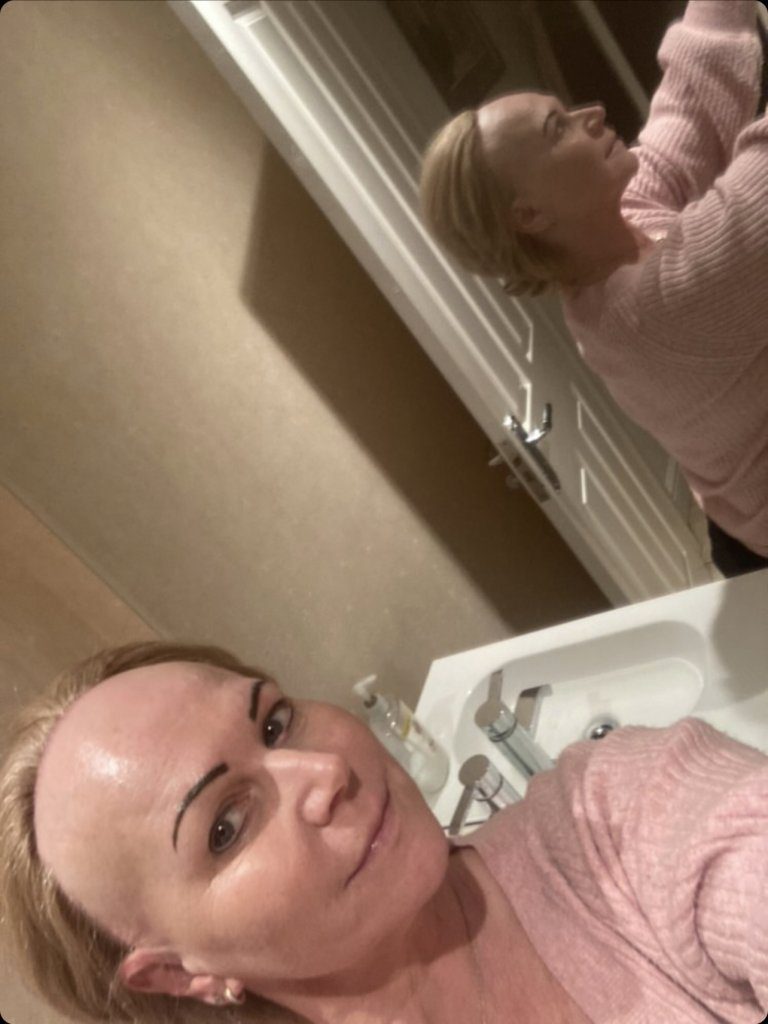 Natasha was diagnosed with frontal fibrosing alopecia, a rare and progressive condition that causes scarring and hair loss in the front of the scalp.