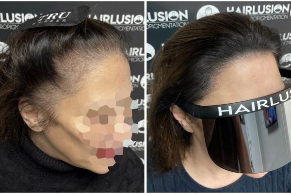 scalp micropigmentation scalp micropigmentation