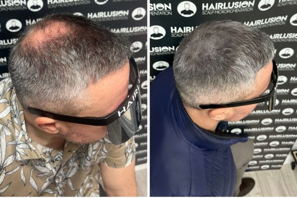 scalp micropigmentation men scalp micropigmentation men