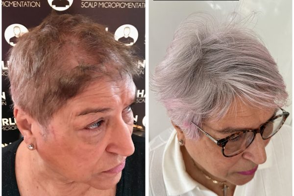 scalp micropigmentation scalp micropigmentation